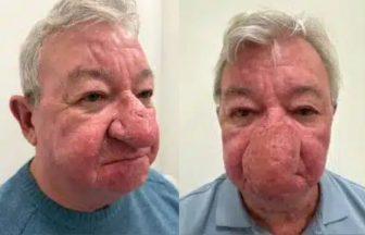 Man unable to kiss wife after ‘one of the worst cases’ of nose swelling