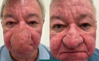 Man unable to kiss wife after ‘one of the worst cases’ of nose swelling