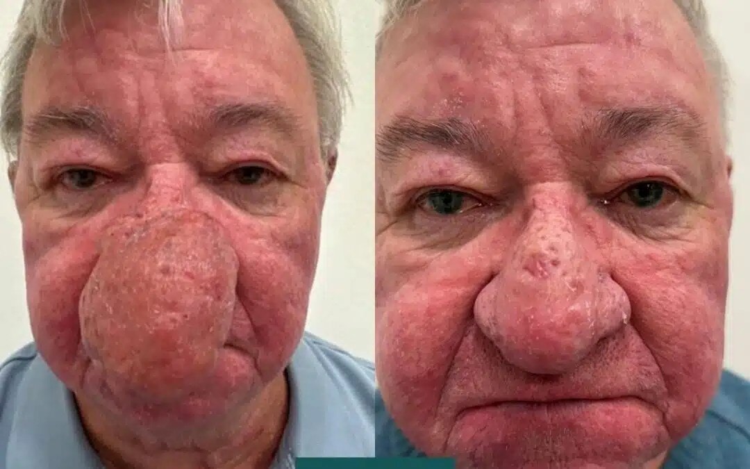 Man unable to kiss wife after ‘one of the worst cases’ of nose swelling