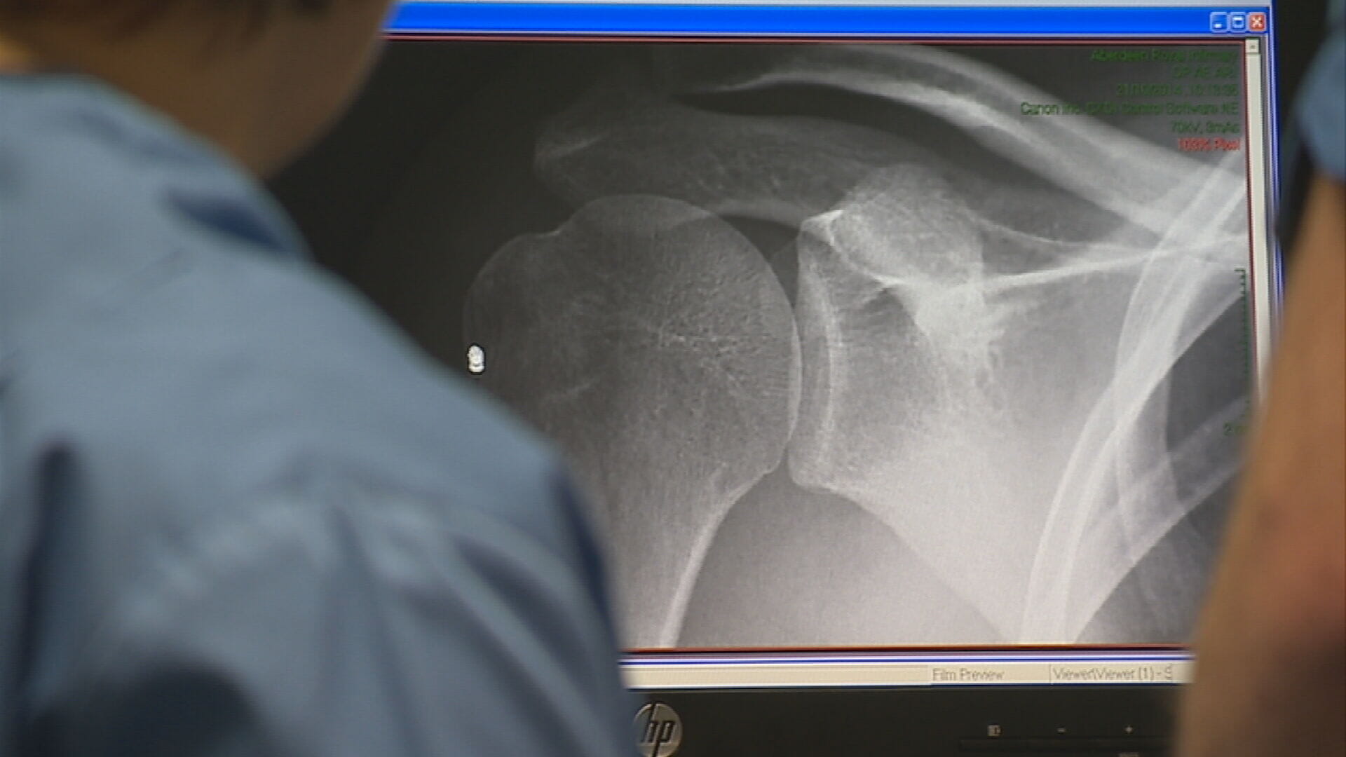 Thousands of people living with arthritis struggle to work, according to a new report