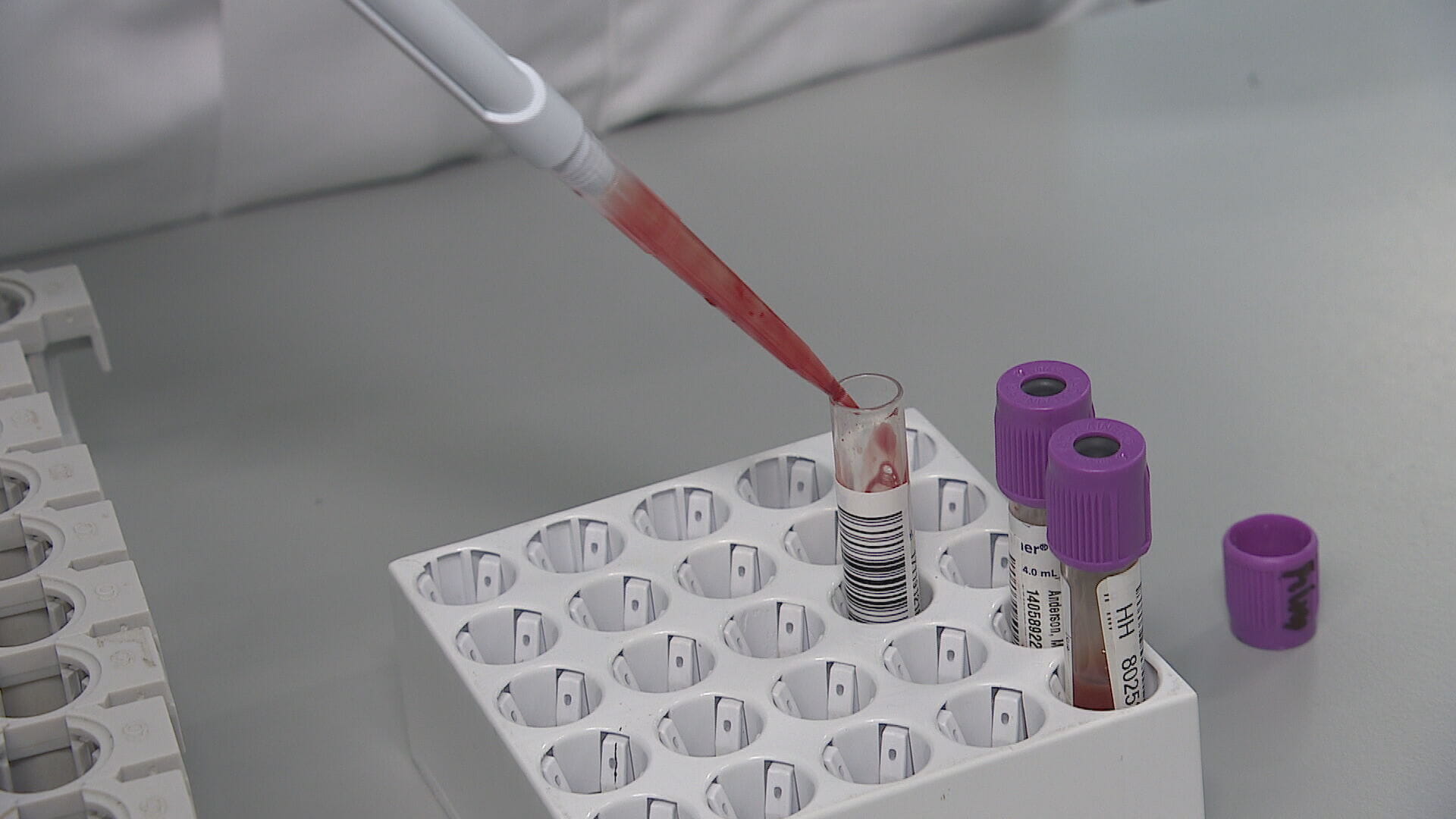 Aberdeen Royal Infirmary introduced Car-T therapy last November