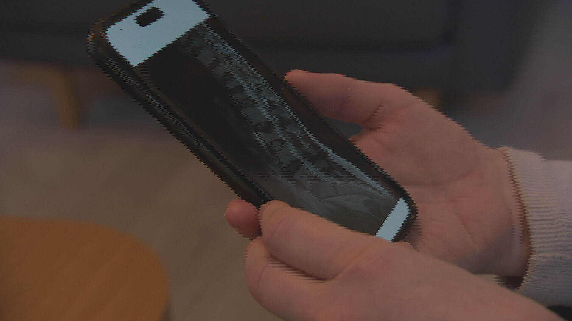 Scans revealed multiple fractures in Kirsten's spine
