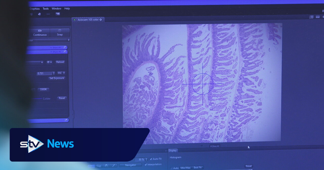 Scotland Tonight: New Glasgow pilot aims to speed up bowel cancer diagnosis