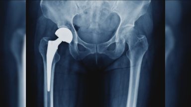 ‘My hip implant almost poisoned me to death’