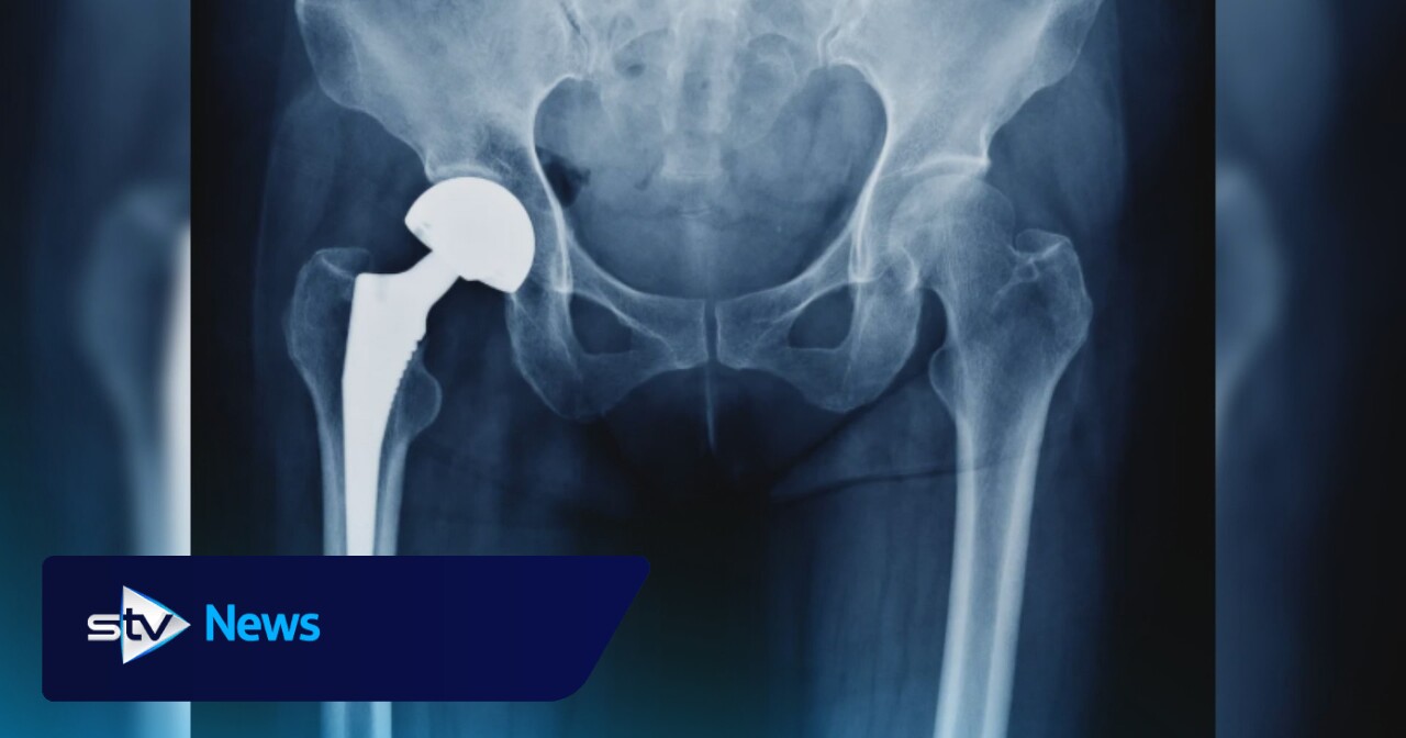 ‘My hip implant almost poisoned me to death'