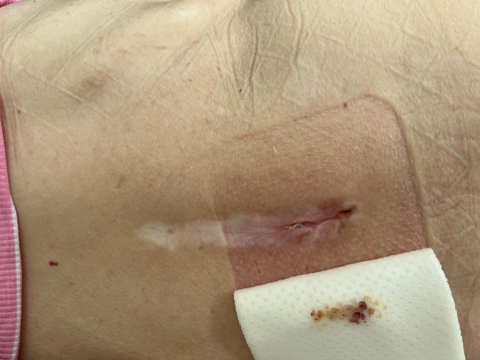 Yvonne has been left with pressure sores