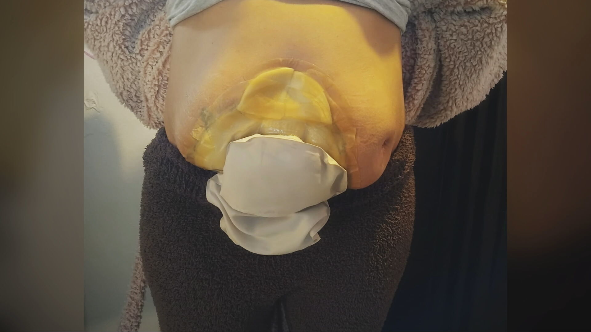 Hather now uses a stoma bag