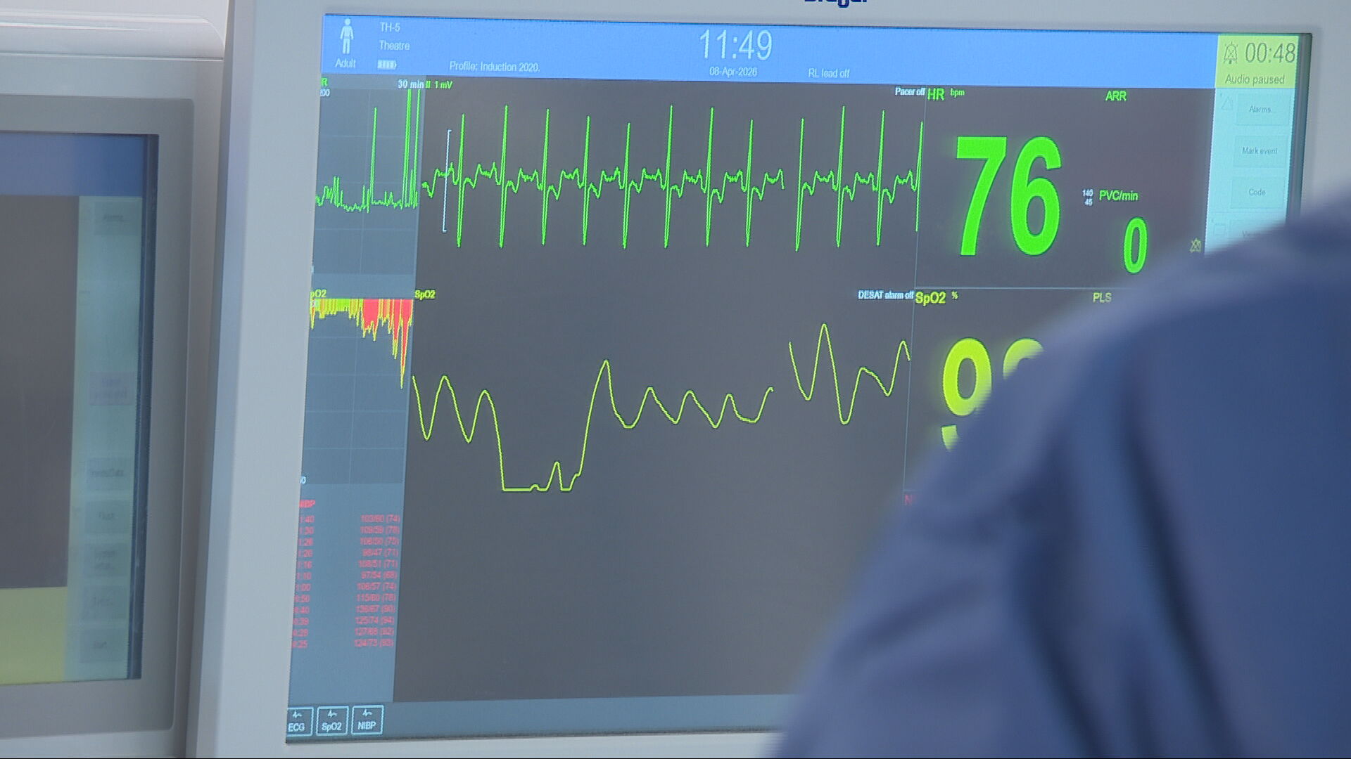 An ECG monitors the patients' heart rate