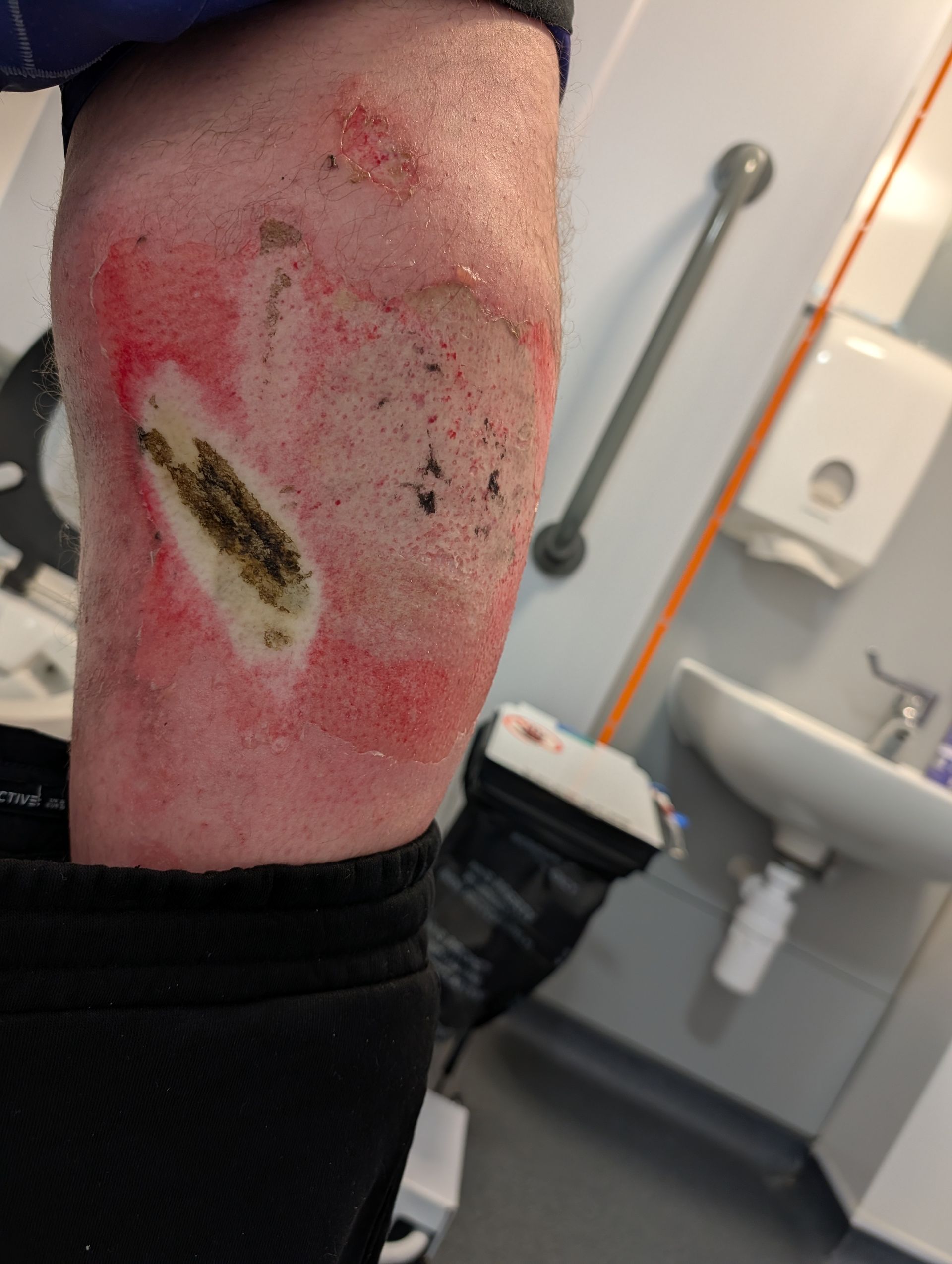 Mr Sutherland was taken by air ambulance to Aberdeen Royal Infirmary for his burns